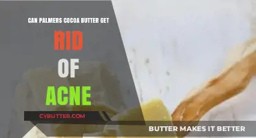 Can Palmer's Cocoa Butter Clear Acne? Benefits and Risks Explained