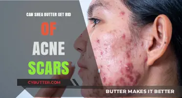 Shea Butter for Acne Scars: Effective Solution or Myth?