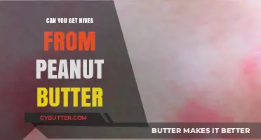 Can Peanut Butter Cause Hives? Understanding Allergic Reactions and Symptoms