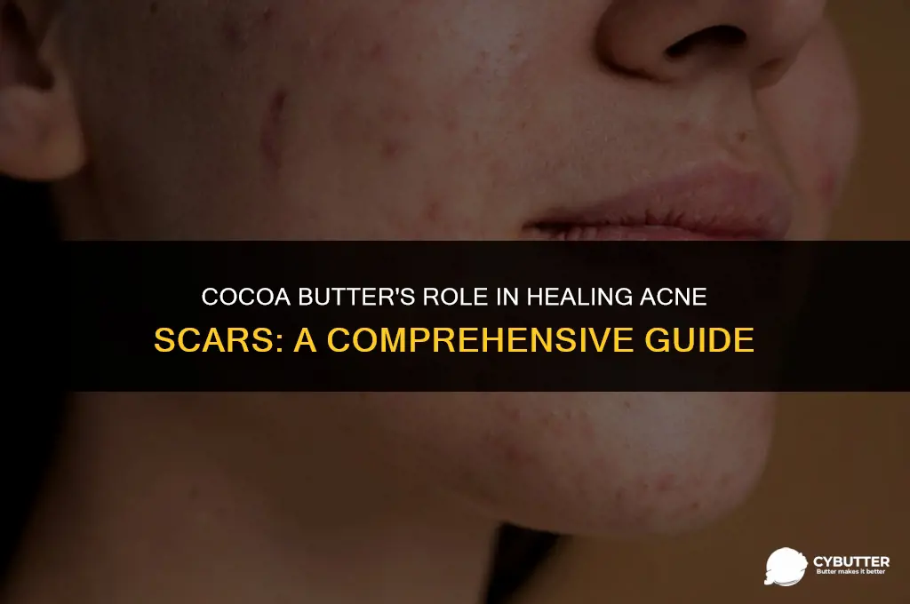 do cocoa butter help with acne scars