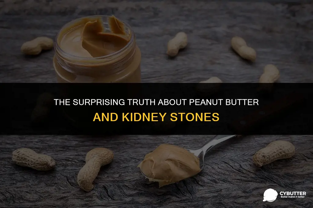 does peanut butter cause kidney stones