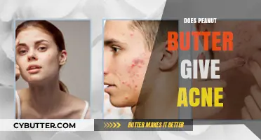 The Truth About Peanut Butter and Acne: A Dermatologist's Insight