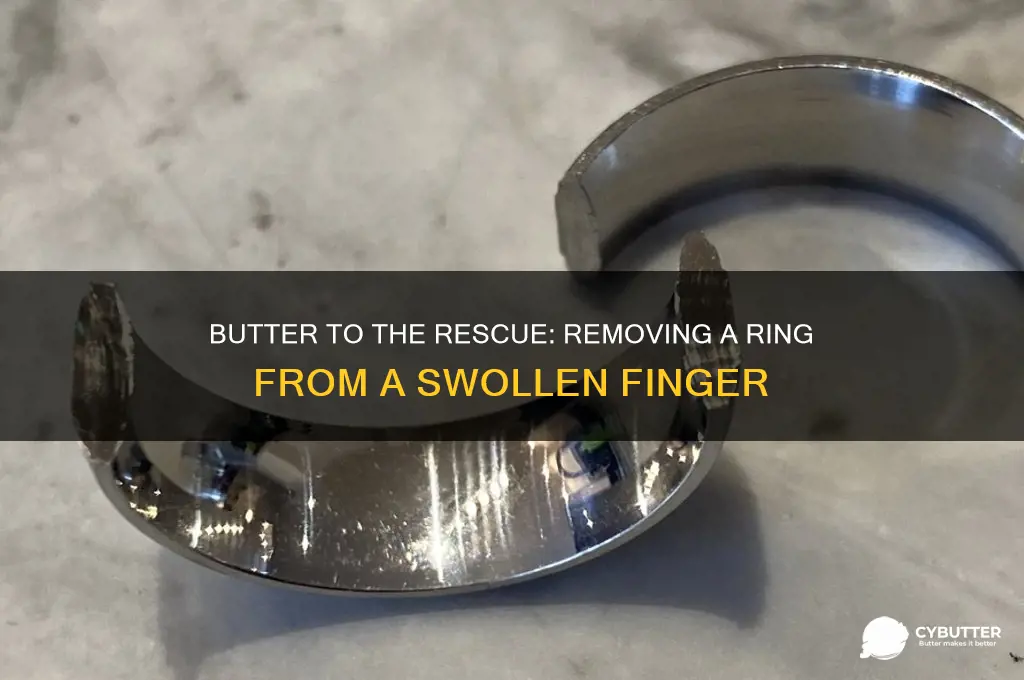 how to get ring off swollen finger with butter