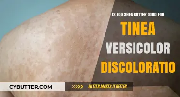Shea Butter for Tinea Versicolor: Effective Remedy for Skin Discoloration?