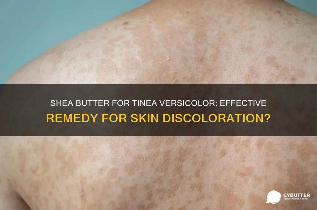 is 100 shea butter good for tinea versicolor discoloration