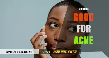 Butter and Acne: Debunking Myths for Clearer Skin