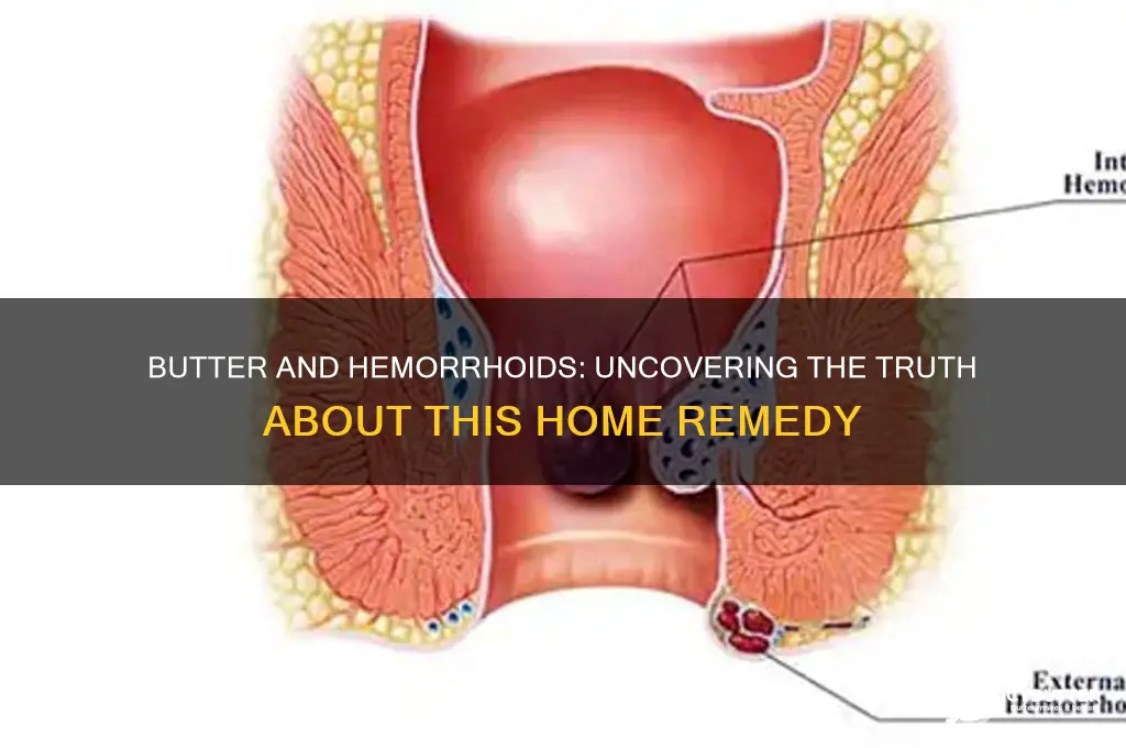 is butter good for hemorrhoids
