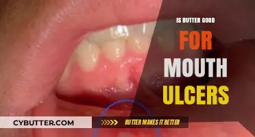 Butter and Mouth Ulcers: A Surprising Remedy or Myth?