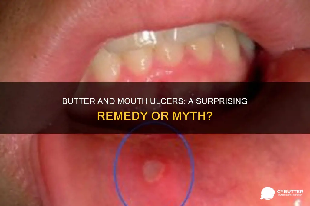 is butter good for mouth ulcers