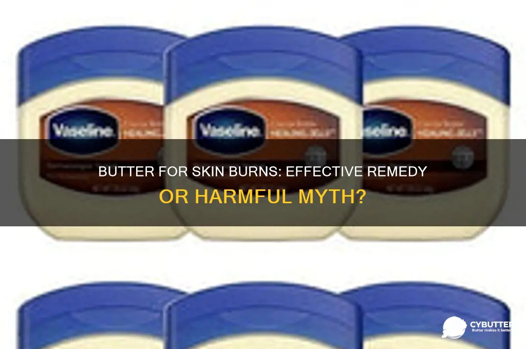 is butter good for skin burns