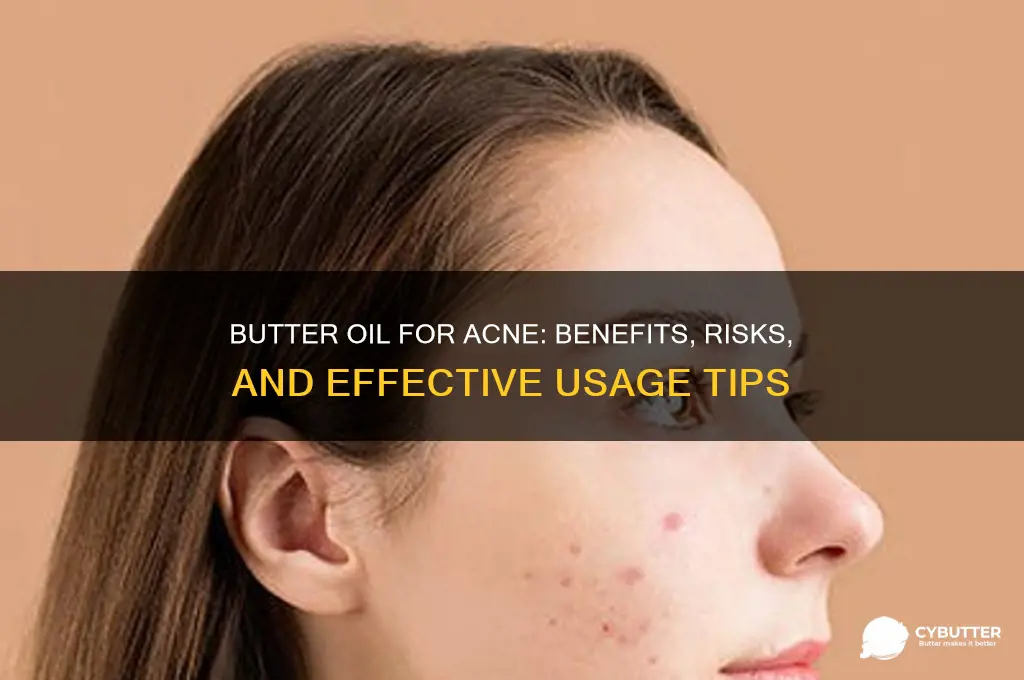 is butter oil good for acne