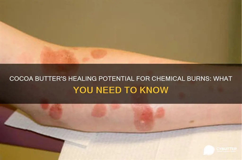is cocoa butter good for chemical burns