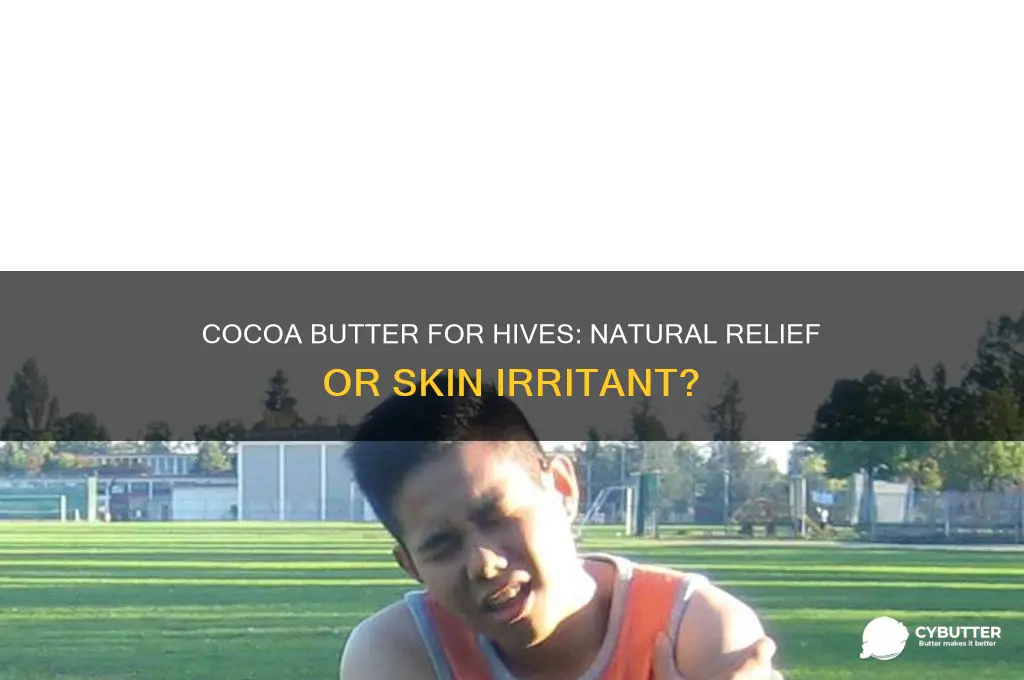 is cocoa butter good for hives