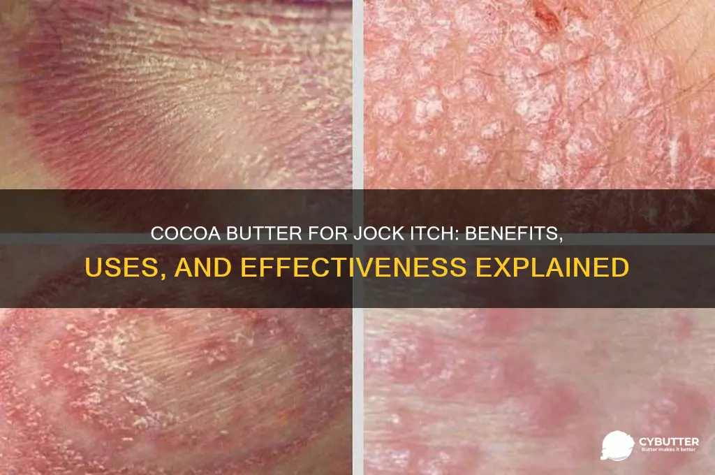 is cocoa butter good for jock itch