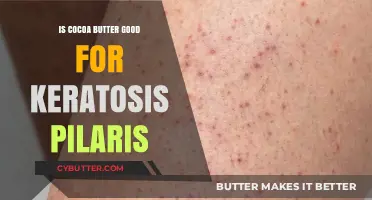 Cocoa Butter Benefits: Effective Treatment for Keratosis Pilaris?