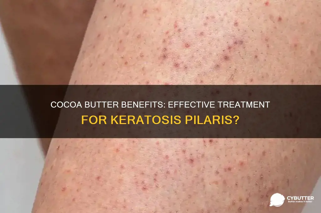 is cocoa butter good for keratosis pilaris
