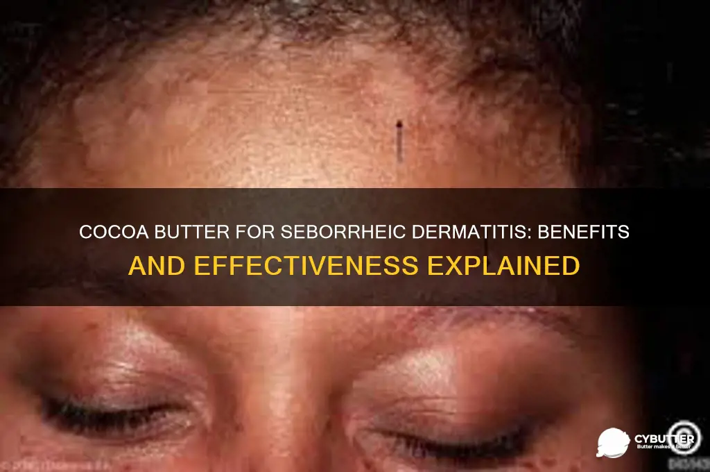 is cocoa butter good for seborrheic dermatitis