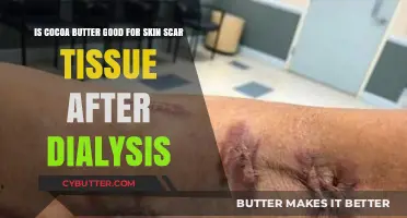Cocoa Butter Benefits: Healing Dialysis-Related Skin Scar Tissue Naturally
