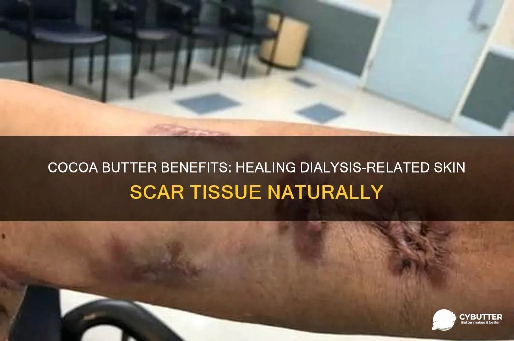 is cocoa butter good for skin scar tissue after dialysis