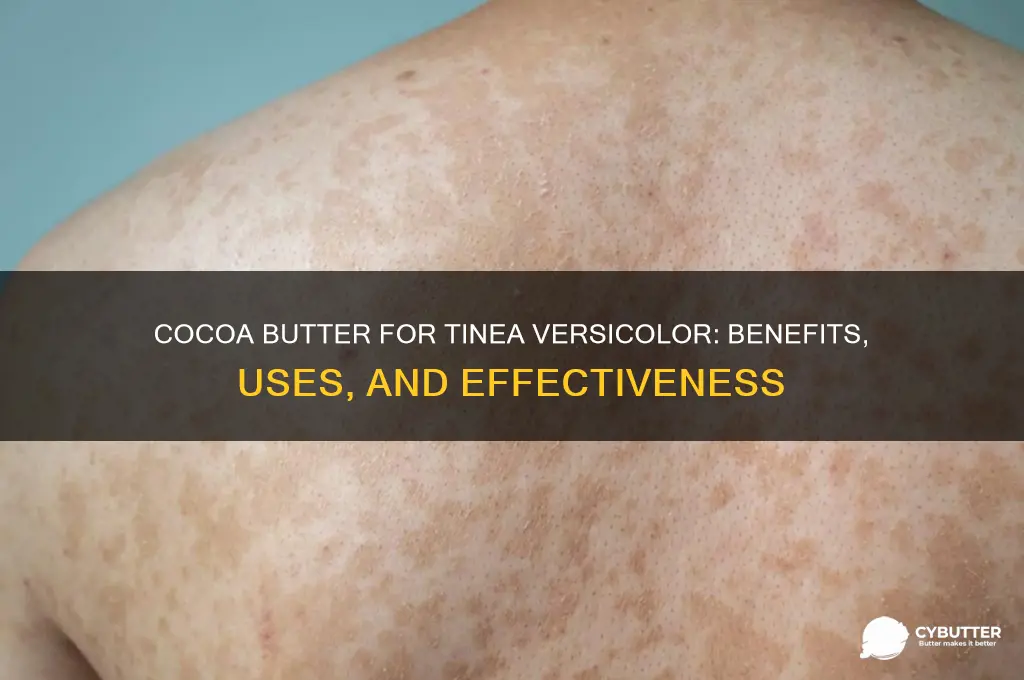 is cocoa butter good for tinea versicolor