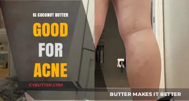 Coconut Butter for Acne: Benefits, Uses, and Skin-Clearing Potential