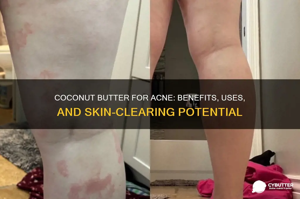 is coconut butter good for acne