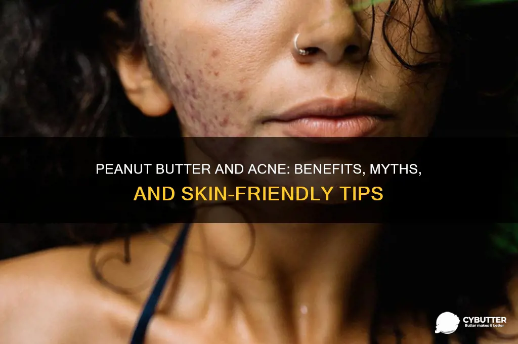 is peanut butter good for acne