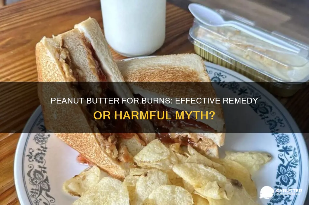 is peanut butter good for burns