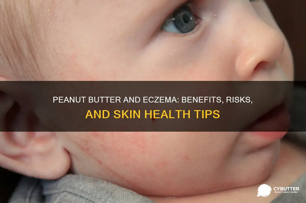 is peanut butter good for eczema