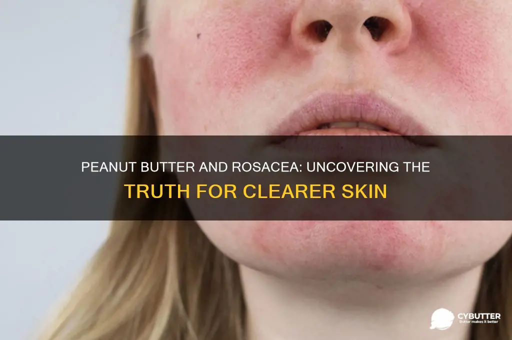 is peanut butter good for rosacea
