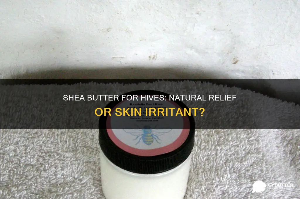 is shea butter good for hives