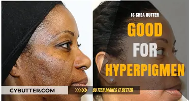 Shea Butter for Hyperpigmentation: Benefits, Uses, and Results Explained