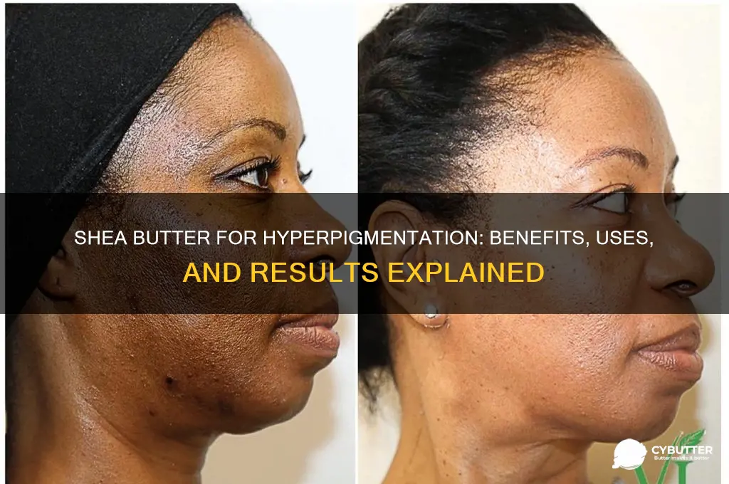 is shea butter good for hyperpigmentation