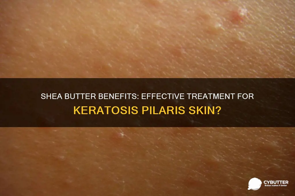 is shea butter good for keratosis pilaris