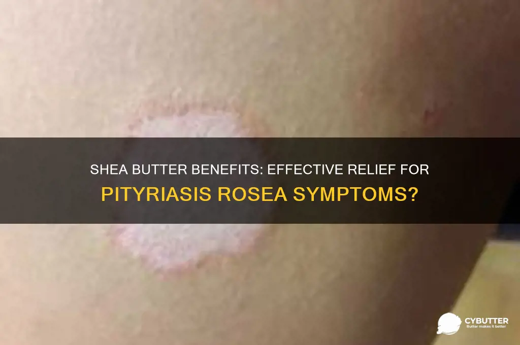 is shea butter good for pityriasis rosea