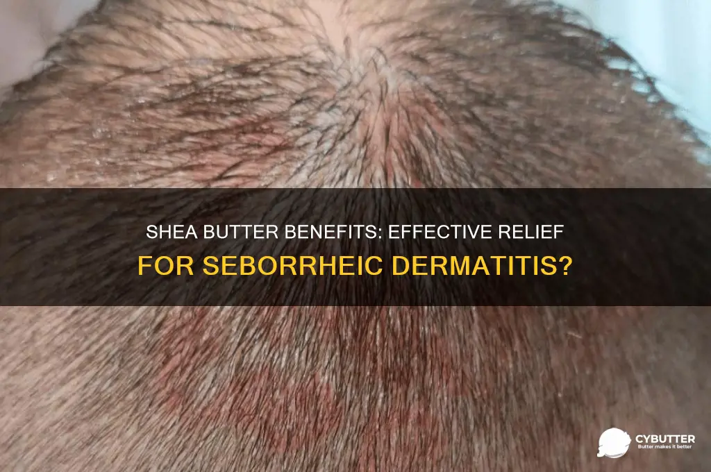 is shea butter good for seborrheic dermatitis