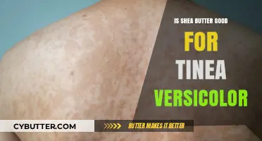 Shea Butter for Tinea Versicolor: Benefits, Uses, and Effectiveness Explained