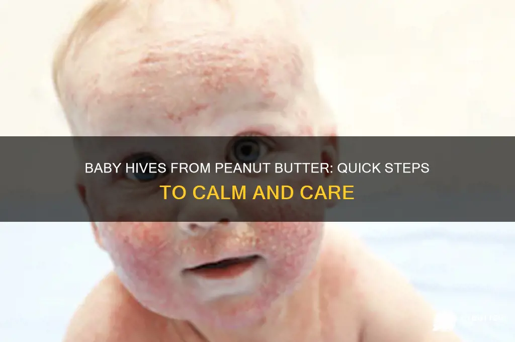 what to do if baby gets hives from peanut butter